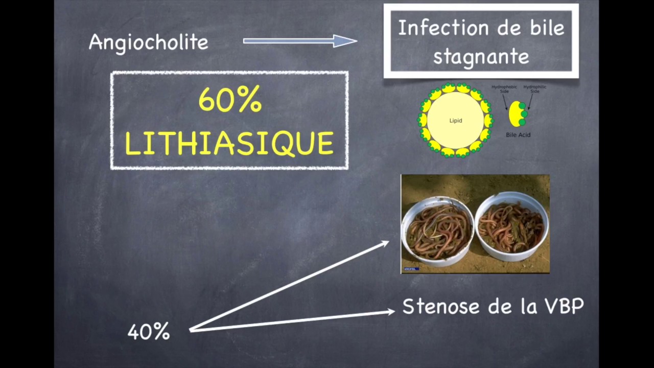 Lithiase Biliaire - 4. Angiocholite