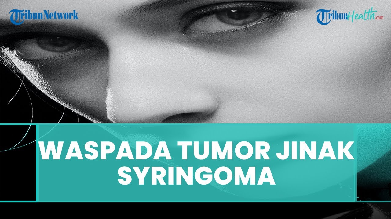Apa itu Syringoma, Kenali Penyebab hingga Cara Mengatasi Tumor Jinak