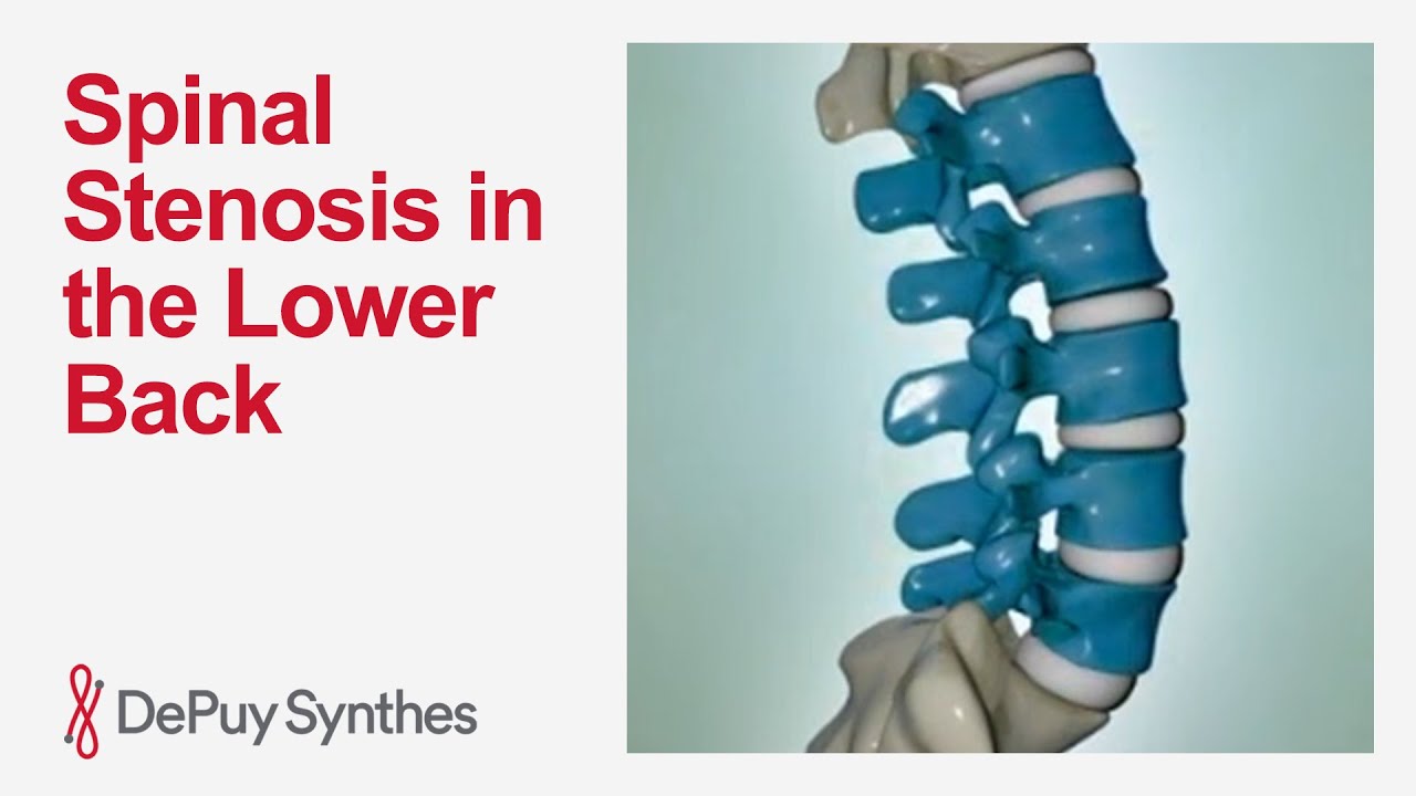 Lumbar Spinal Stenosis: Lower Back Pain Causes, Symptoms and Treatment | DePuy Synthes
