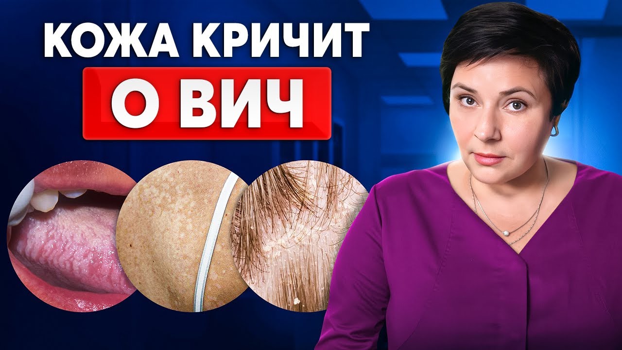 Как проявляется ВИЧ на коже? ПЕРВЫЕ ОПАСНЫЕ СИМПТОМЫ