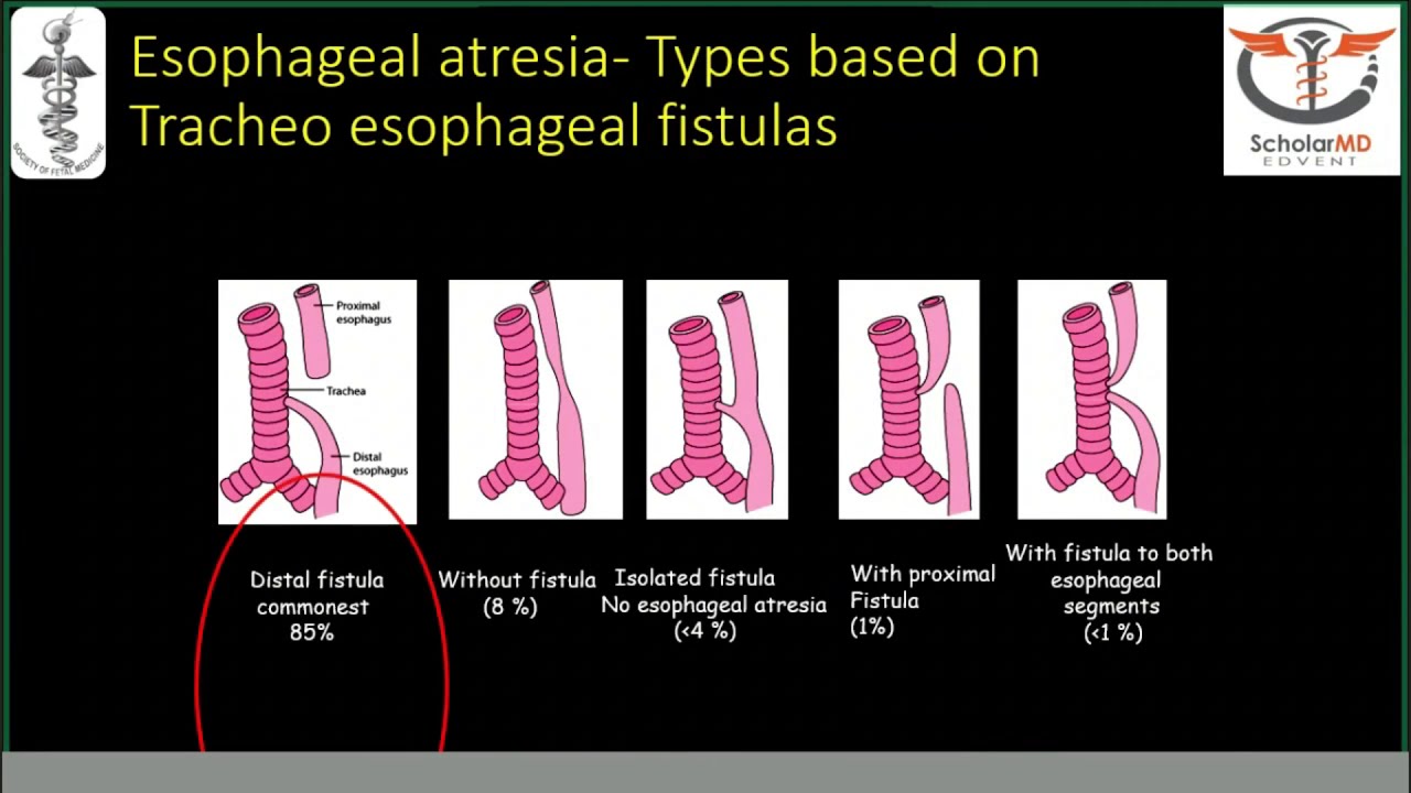 GE Webinar: Fetal GIT Obstructions by Dr Bimal J. Sahani