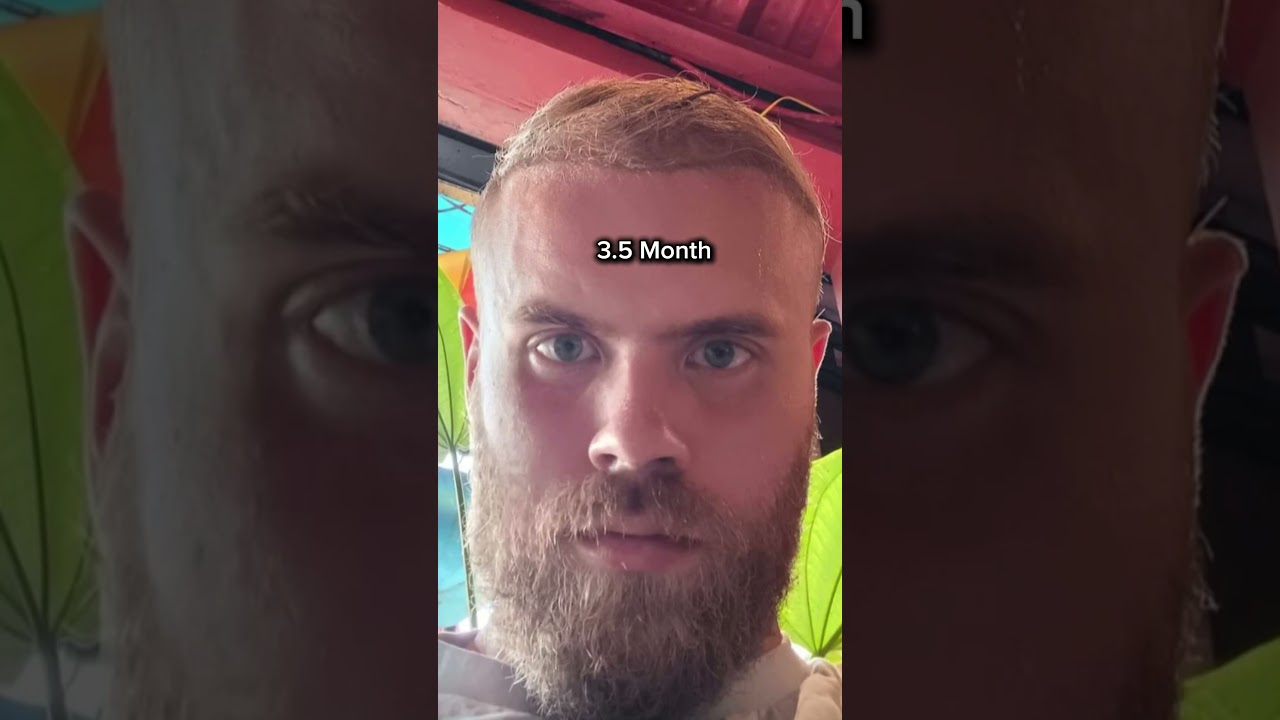 Transformation in the First 4 Months After Hair Transplant