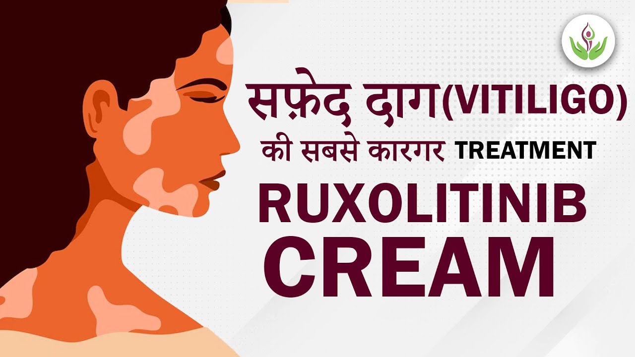 Ruxolitinib Cream - Latest Treatment For Vitiligo 2023 | Care Well Medical Centre