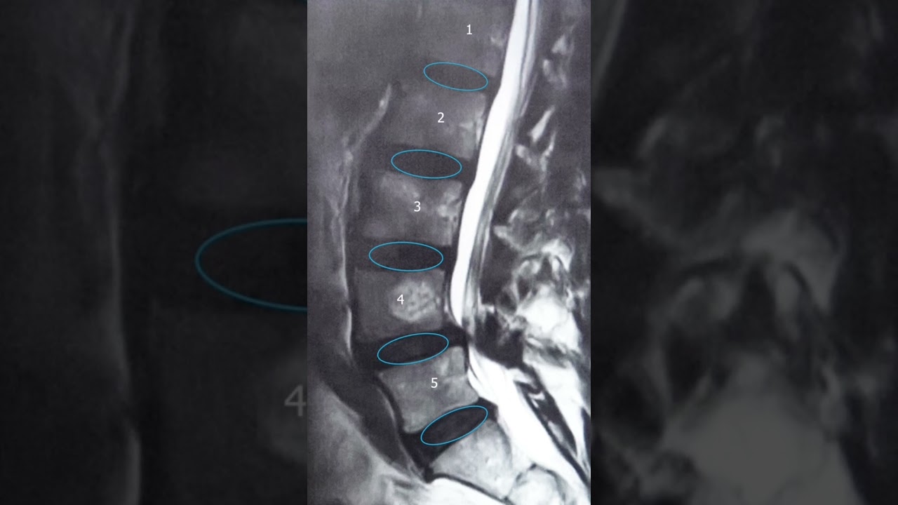 How to read an MRI of the lower back