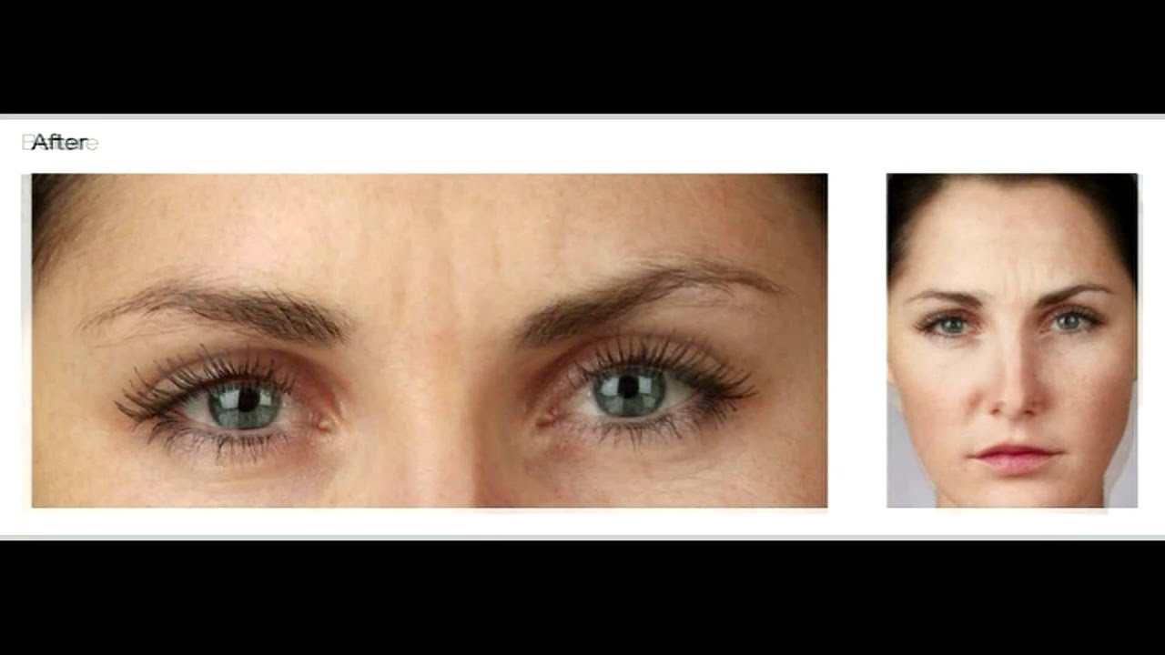 Orange County Botox | Orange County Spa