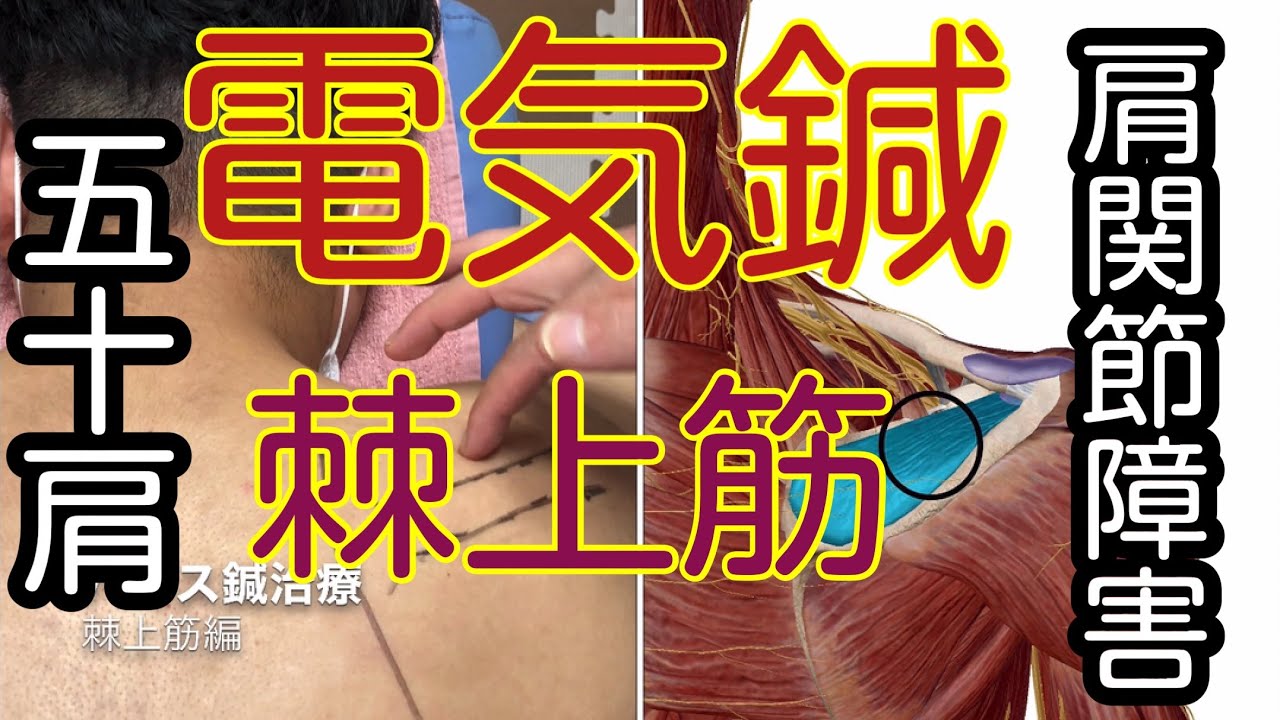 棘上筋のパルス（電気）鍼治療、五十肩や肩関節障害に