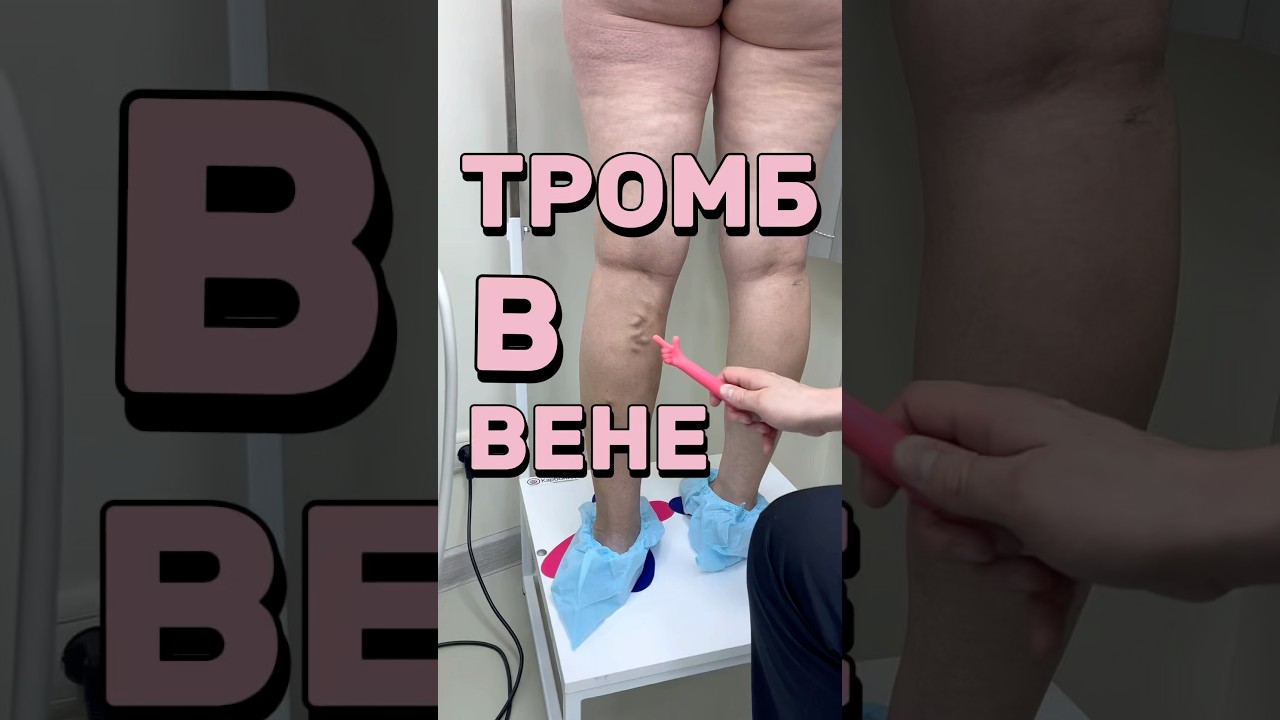 А вы бы согласились убрать варикоз лазером? #варикоз #лазер #тромбоз
