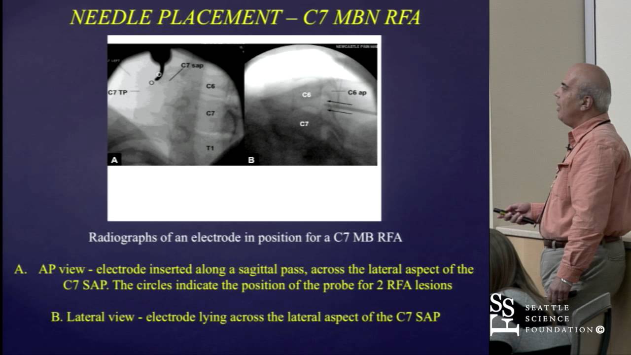 Cervical Radio-frequency Neurotomy Techniques by Mario De Pinto, M.D.