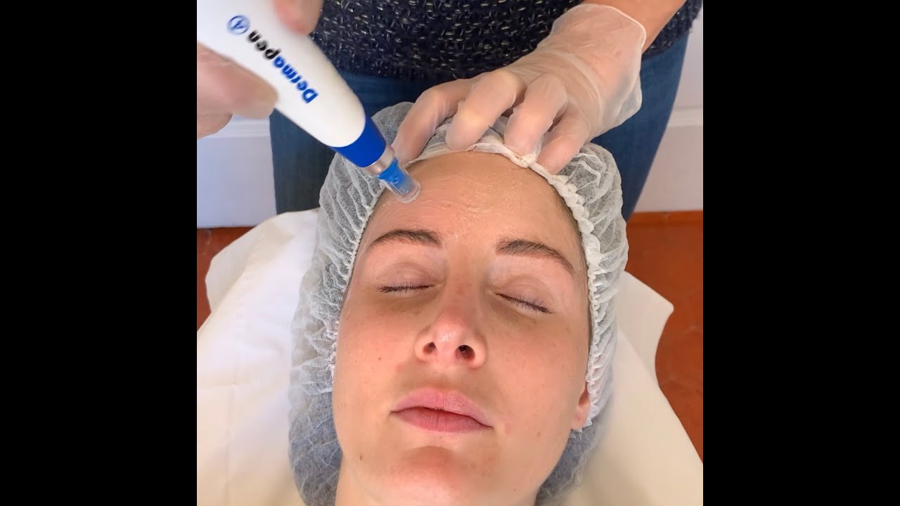 Séance de microneedling avec DERMAPEN 4 (dispositif médical)- Dr Janick ENJELVIN - Aix en Provence