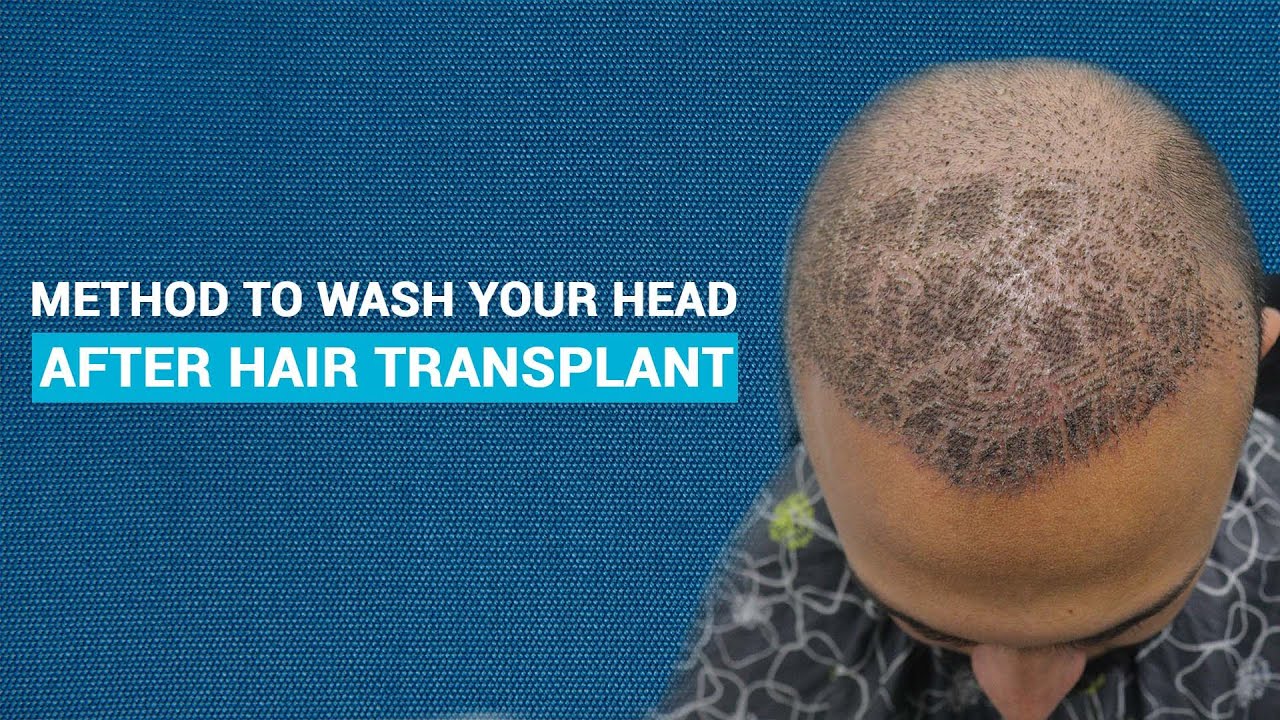 Hair Wash After 7-10 Days of Hair Transplant | JJ Aesthetics