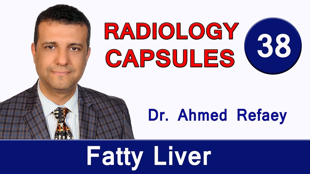 Capsule 38 : Fatty Liver