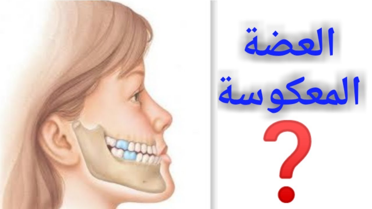 تشخيص وعلاج العضه المعكوسة  كيف يتم؟  - كلاس 3 تقويم الأسنان - تقويم الفكين - بروز الفك السفلي