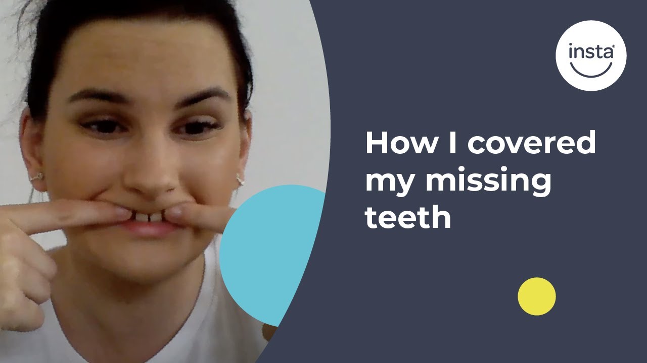 Shona's Story | Covering Missing Teeth | Instasmile Review