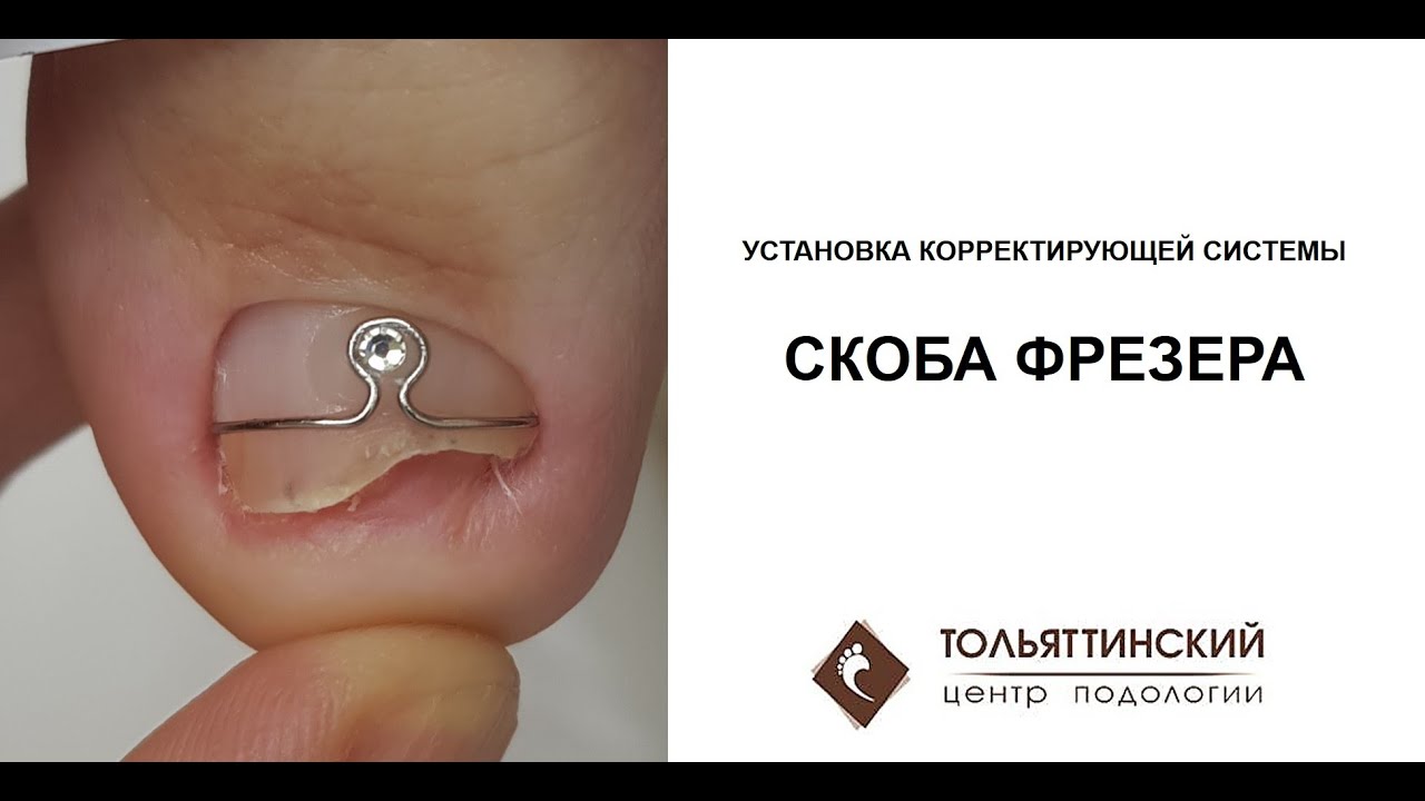 Скоба Фрезера - установка