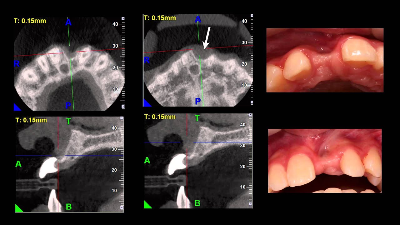 Step 1. Straumann BLT implant: Introduction and Treatment Plan in the anterior maxilla
