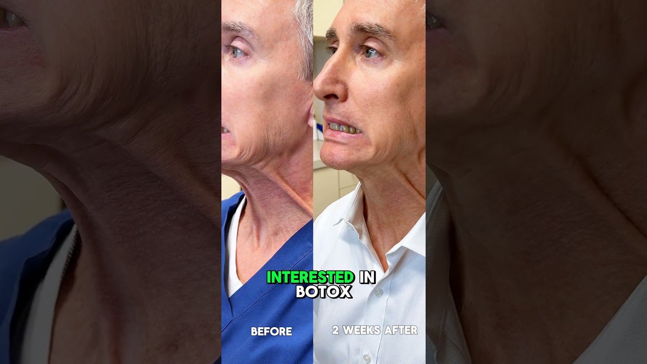 Two Weeks After Neck Botox&hellip; WOW! (Dr. Ruff&rsquo;s Results) | West End Plastic Surgery