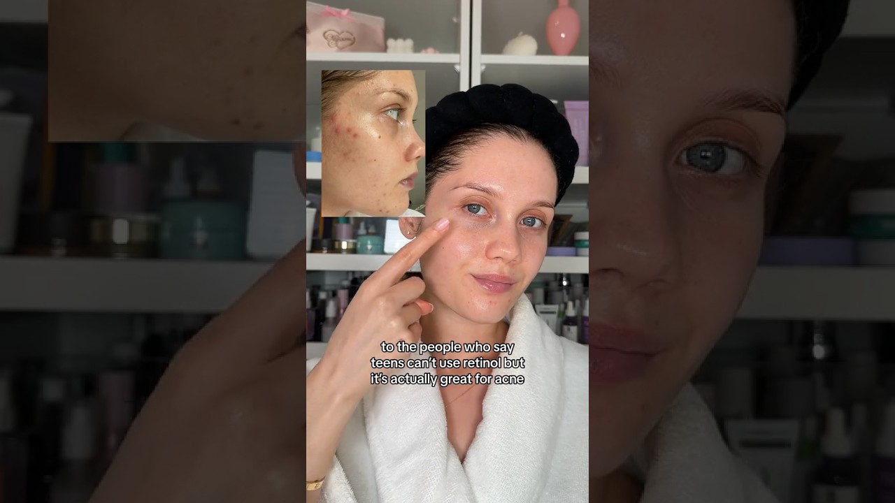 RETINOIDS 4 ACNE💗 