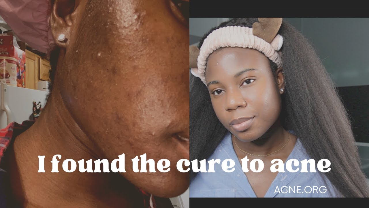 I FOUND THE CURE TO ACNE | ACNE.ORG 2 MONTHS REVIEW