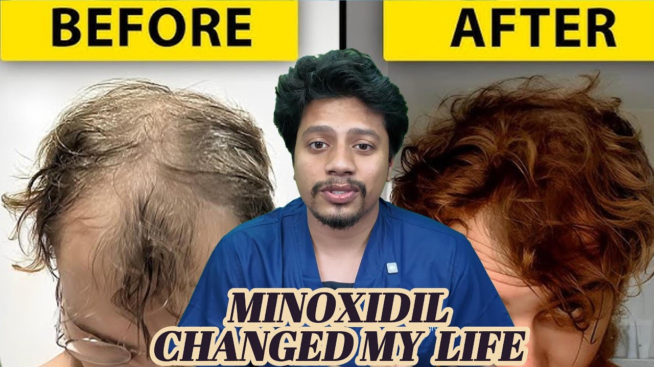 minoxidil. hair fall solution. hair transplant. hair care.
