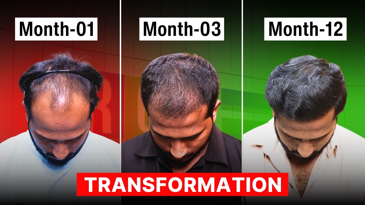 Hair Transplant Case Study | Medicines for Life? | Another Transplant Needed?