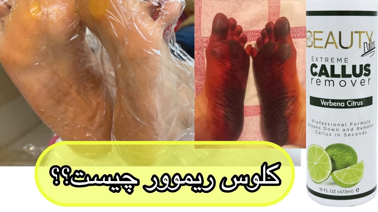 طرز استفاده از کالوس پا...آموزش پدیکور کالوس تراپی تخصصی'✅قسمت اول