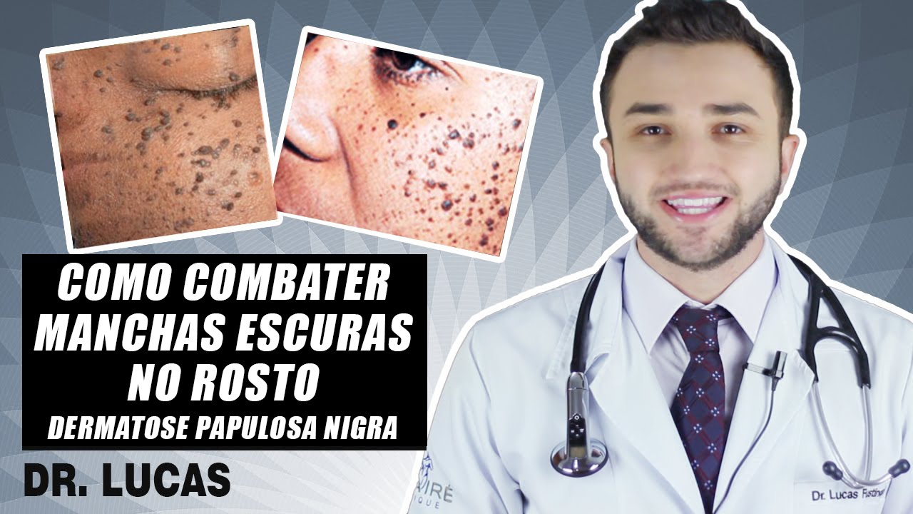 Como combater manchas escuras no rosto?  (DERMATOSE PAPULOSA NIGRA) DR LUCAS FUSTINONI
