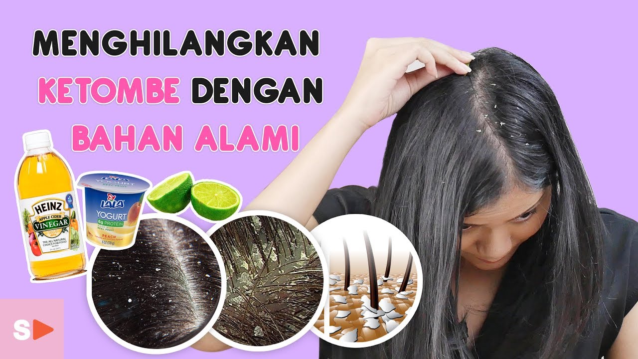 Solusi Ampuh! Begini Cara Menghilangkan Ketombe Dengan Bahan Alami