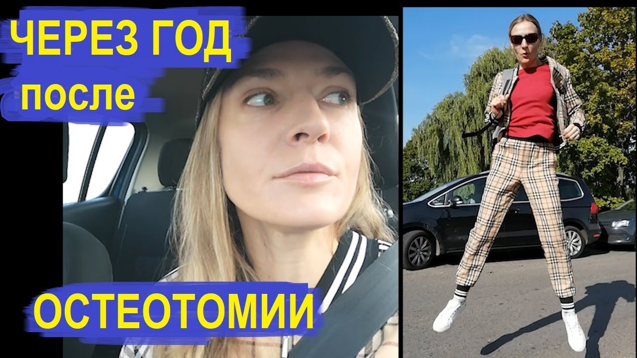 1 год после остеотомии: общее состояние, вопросы врачу, результаты.