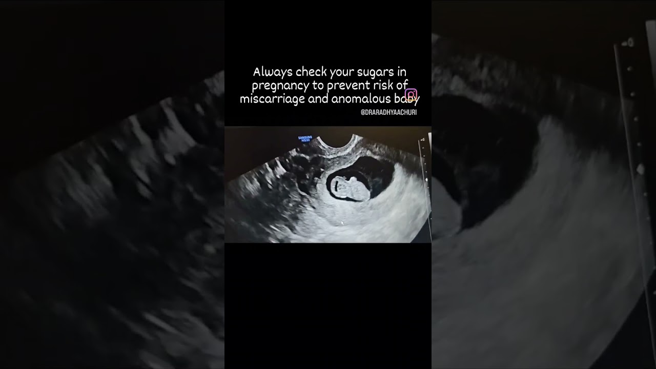 Diabetes in pregnancy can happen to anyone - check ur sugars 