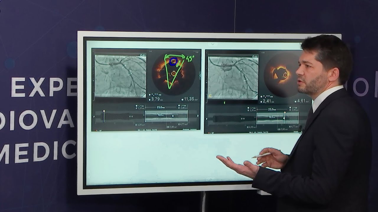 Left main and bifurcation stenting optimised by intracoronary imaging - Webinar