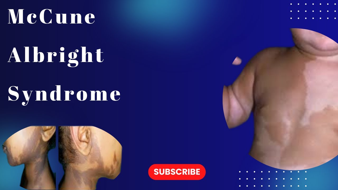 McCune  Albright Syndrome