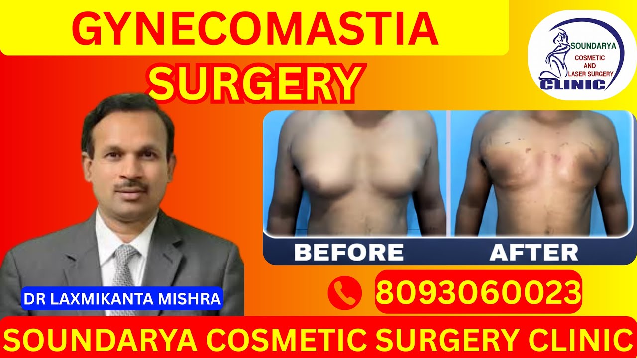 GYNECOMASTIA SURGERY IN BHUBANESWAR | MALE BREAST REDUCTION