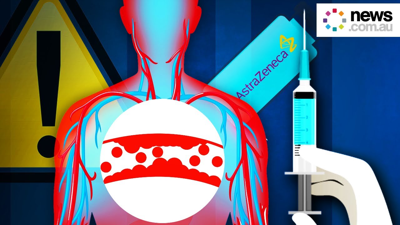AstraZeneca: clot risks and symptoms