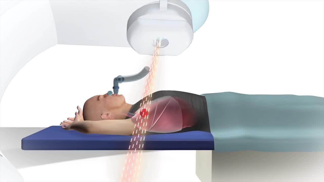 Active Breathing Coordinator (ABC) Device for Lung Cancer or Abdominal Tumors