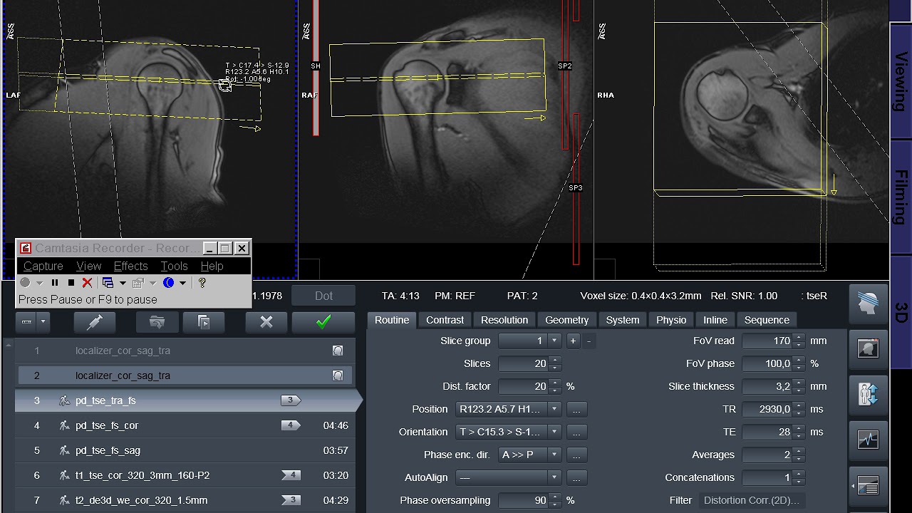 MRI planning Shoulder