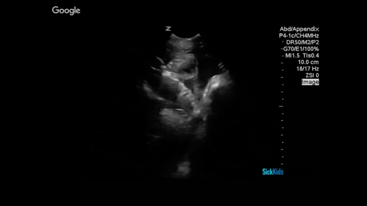 Bowel Obstruction & Fecal Retention (1/2)