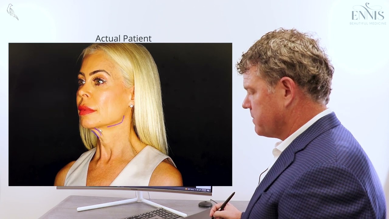 myEllevate Neck Lift Procedure
