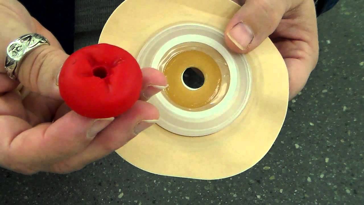 All About Ostomies