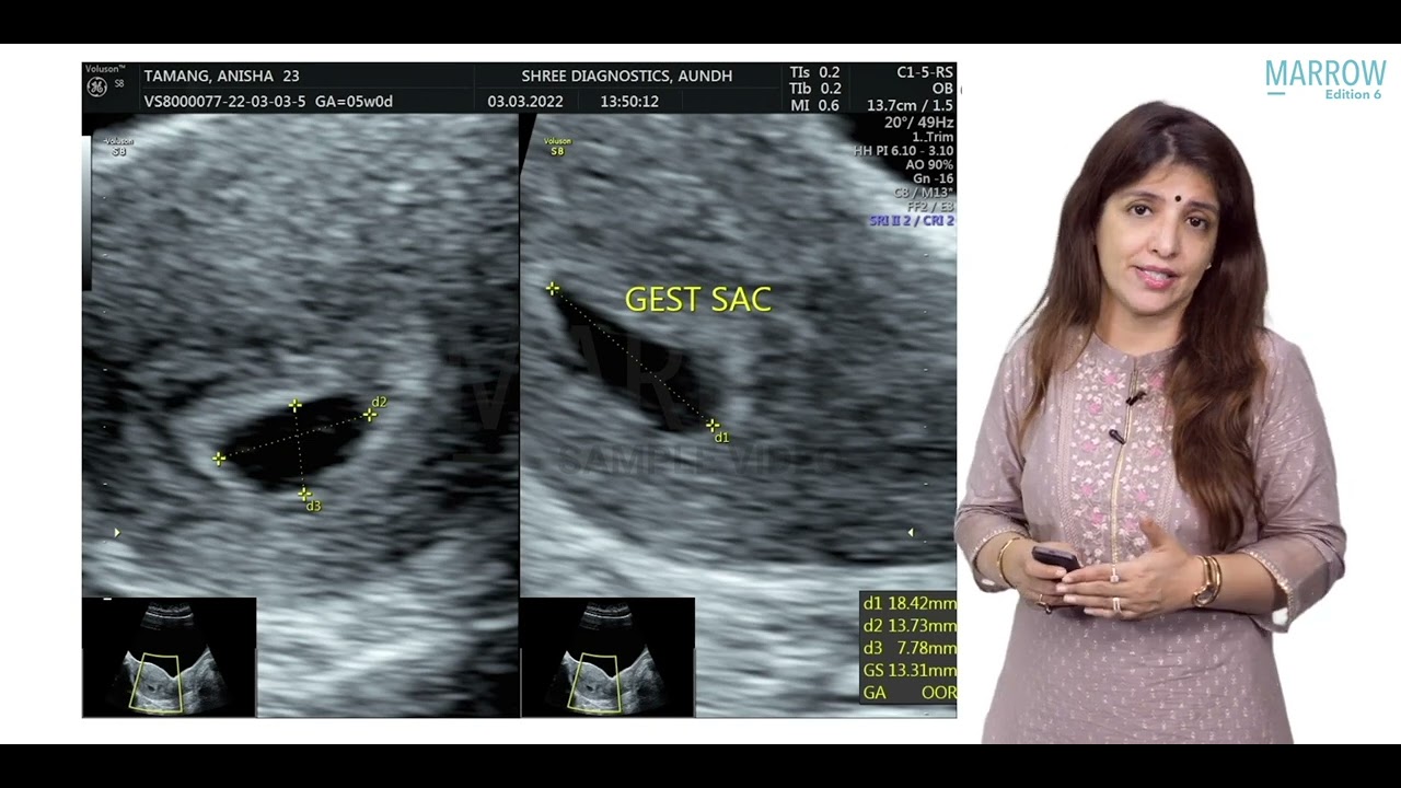 E6 Sample Video: Intrauterine pregnancy (OBG)