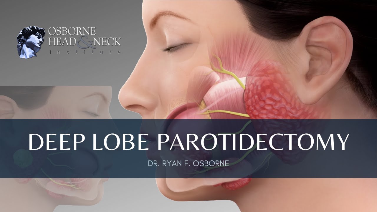 Deep Lobe Parotidectomy Procedure Explained By Dr. Ryan Osborne of Osborne Head & Neck Institute