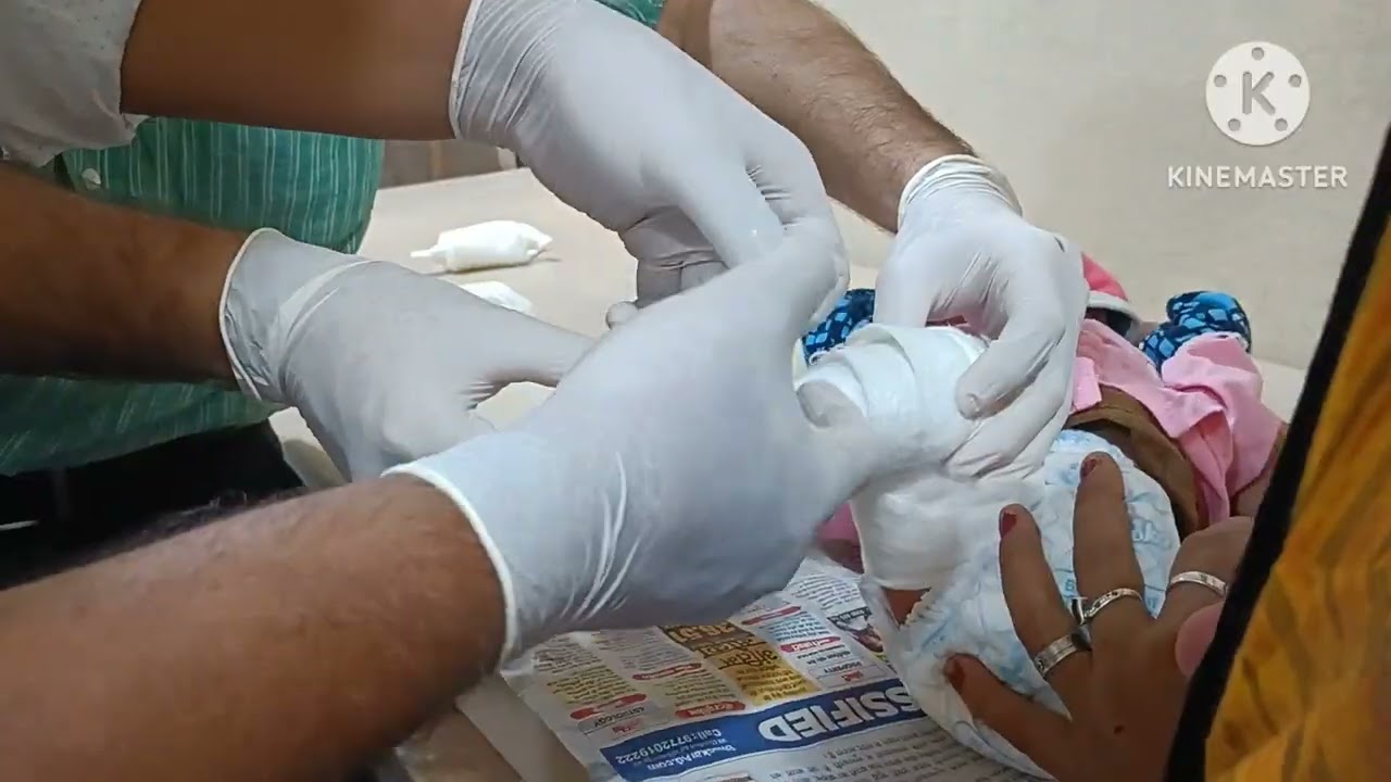 क्लब फुट में प्लास्टर केसे लगाया जाता है How to apply plaster in Clubfoot Best treatment of clubfoot