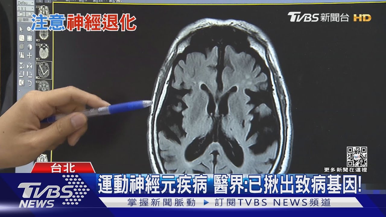 臨床常見「腦神經退化性疾病」出現這幾種症狀..勿拖延!｜十點不一樣20220407