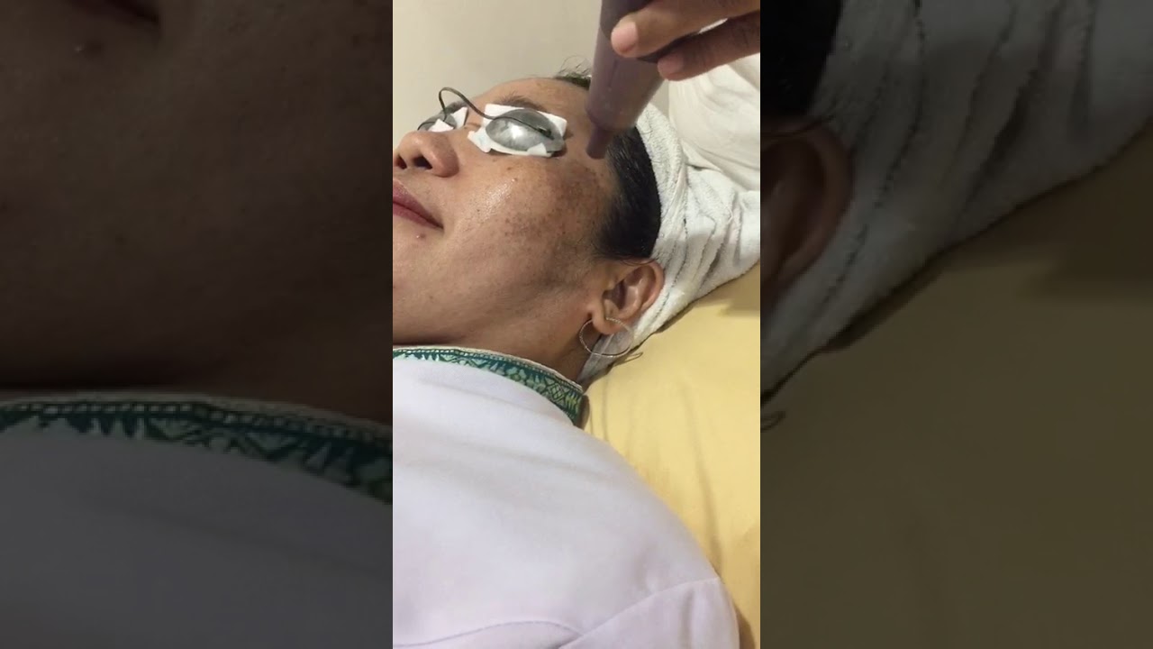 Laser Nd Yag Treatment Untuk Memudarkan Flek-Flek Hitam Pada Wajah