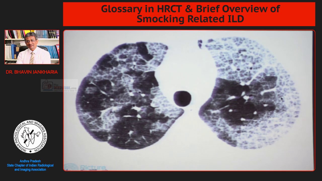 Ground Glass Opacity - Many Reason - Solve the riddle