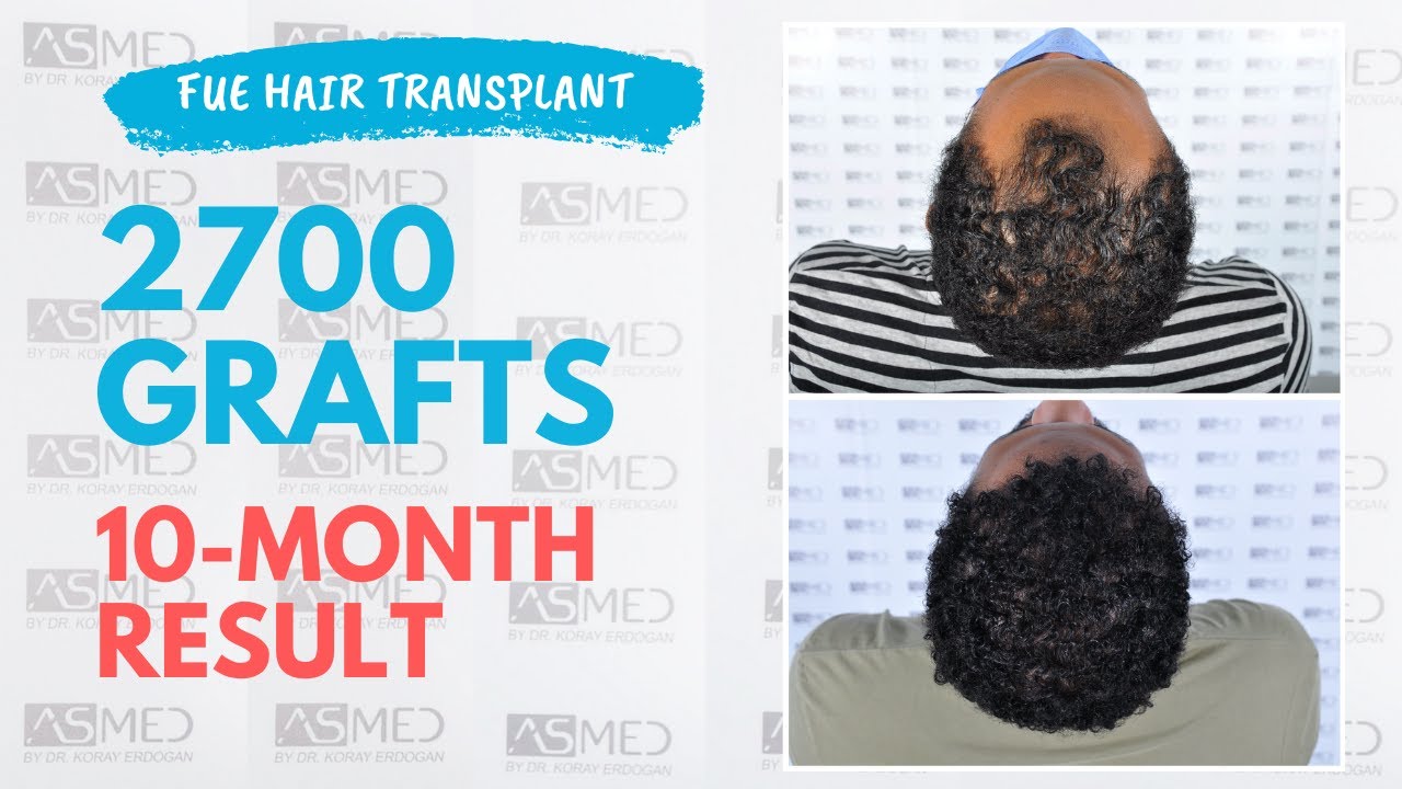 Manual FUE Hair Transplant Before & After 2700 Grafts 10-Month Result - ASMED - Dr. Koray Erdogan