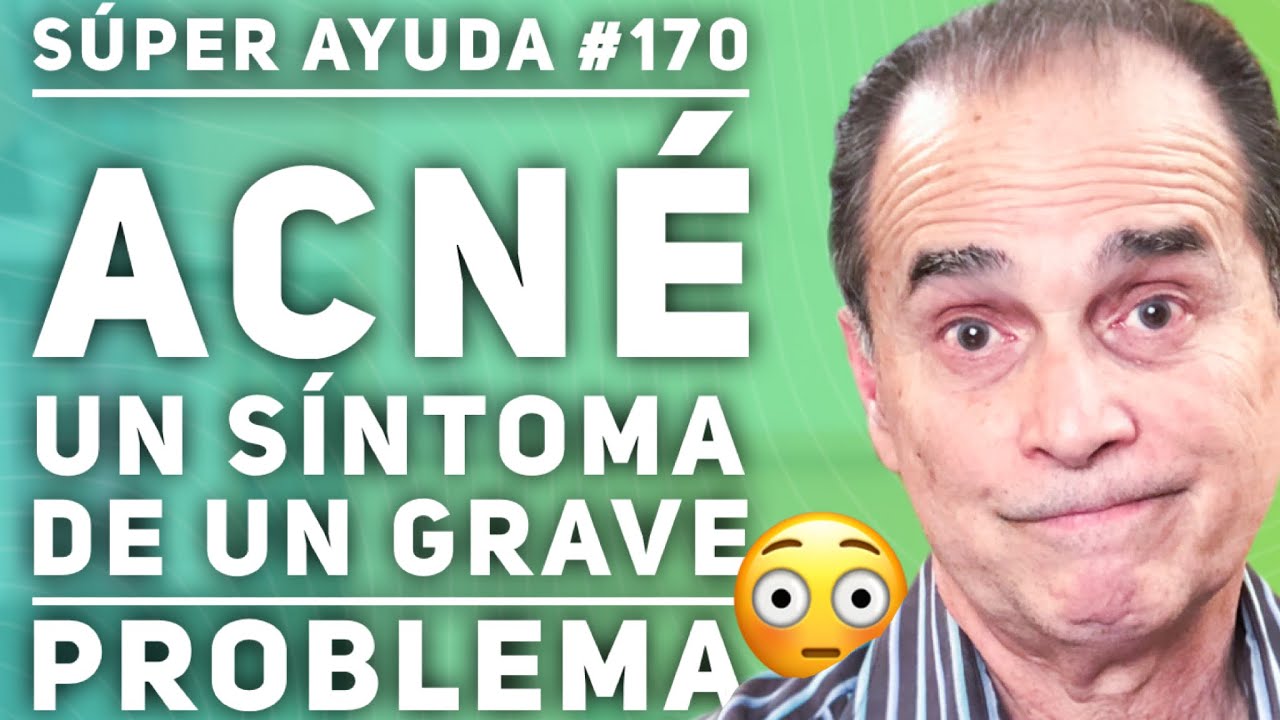 S&Uacute;PER AYUDA #170 Acn&eacute;, Un S&iacute;ntoma De Un Grave Problema