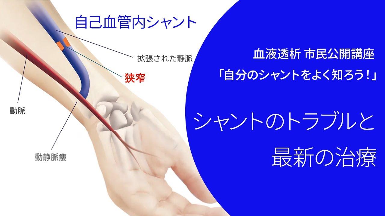 血液透析 シャントのトラブルと最新の治療【市民公開講座】