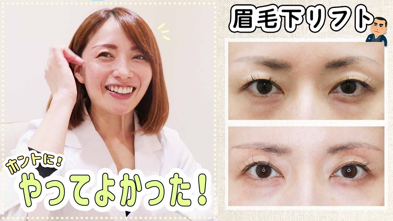 【眉毛下リフト】ドクター永井も大絶賛！重い瞼とはお別れしました…！【美容整形】