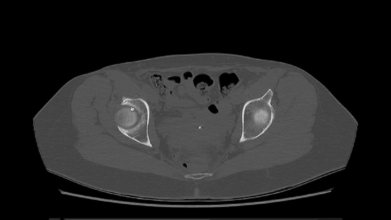 Anatomía CT Pelvis y Caderas