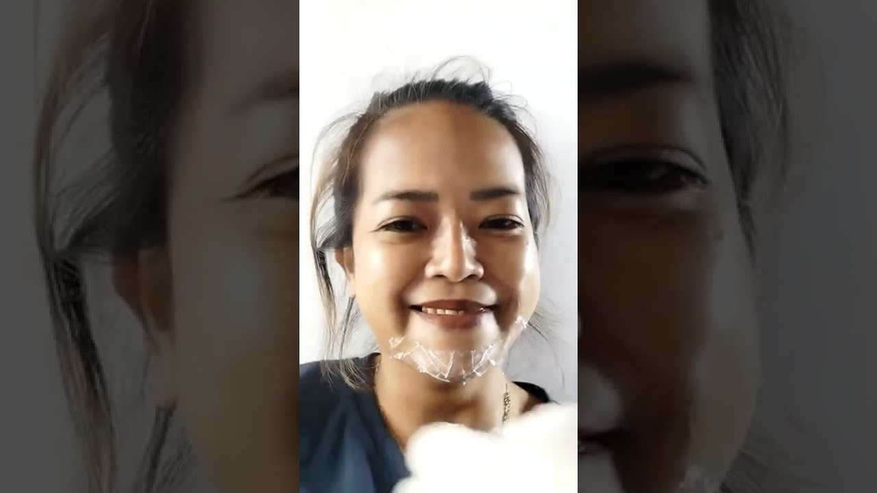 chin filler instant hugis bigas face by arya aesthetic the beauty lounge malolos bulacan